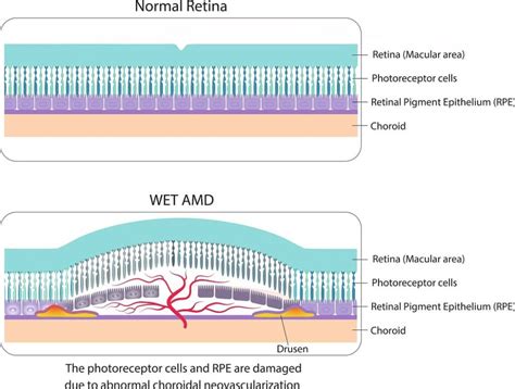 Wet vs. Dry Macular Degeneration: What’s the Difference? | Discover Vision