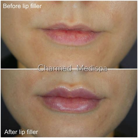 Lip Flip Versus Lip Filler Injections Charmed Medispa Delaware