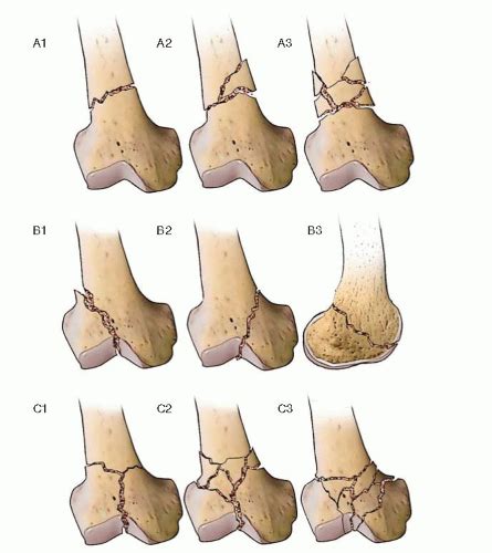 Distal Femur Fracture Classification / Periarticular Fractures of the Knee in Polytrauma ...