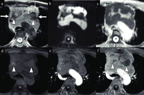 Seminoma In A 38 Year Old Man A An Axial TSE T2 Weighted Image Shows