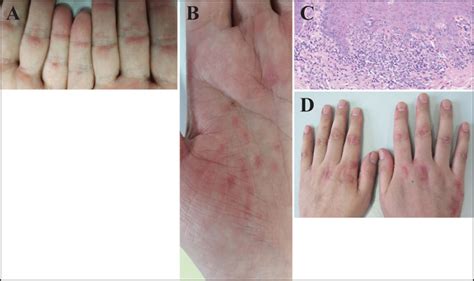 Jle European Journal Of Dermatology A Case Of Dermatomyositis