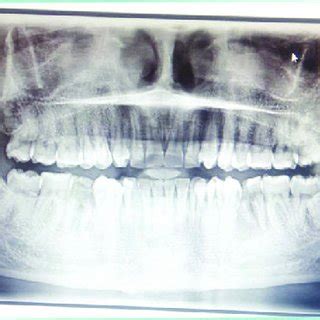 Orthopantomograph Of The Patient For Evaluation Of Complete Dentition