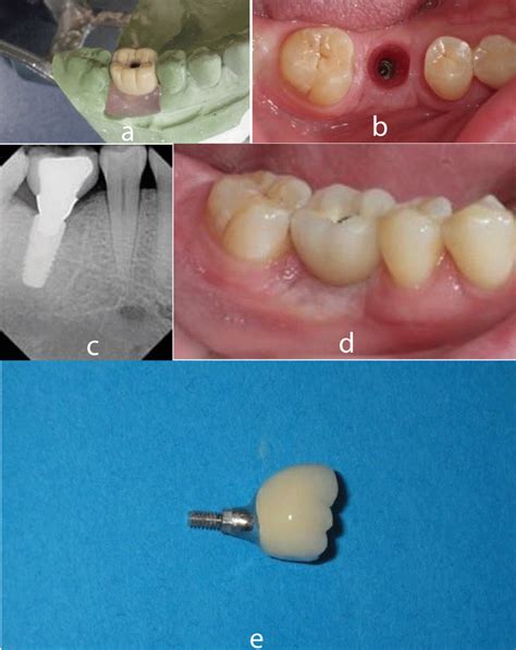 Preventing Peri Implantitis With A Proper Cementation Protocol And With