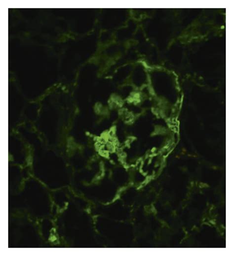 Immunofluorescence Microscopy Granular Predominantly Mesangial