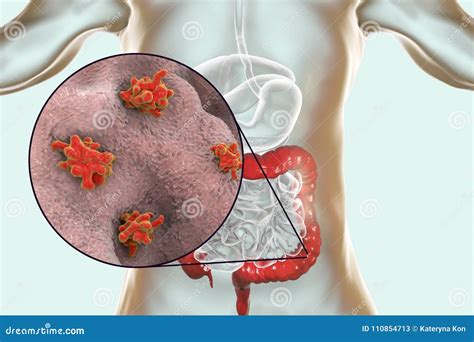 Entamoeba Histolytica Protozoan Infection Of Large Intestine Royalty Free Illustration