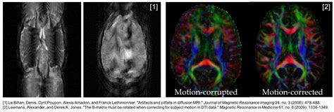 Motion Artifacts In Diffusion Imaging