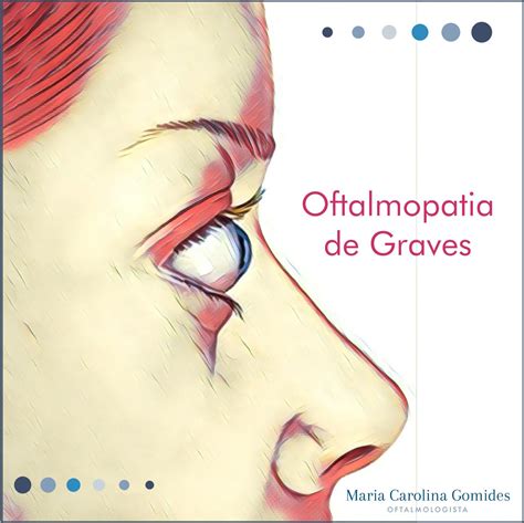 Oftalmopatia de Graves Dra Carolina Gomides Oftalmologista São