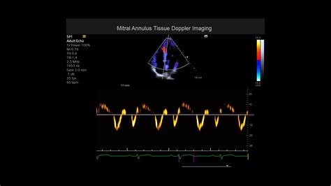 Acuson Juniper Cv Edition Ultrasound System Siemens Healthineers Usa