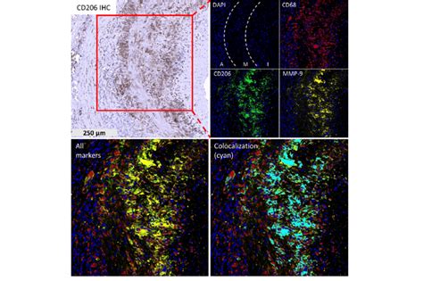 MMP 9 Is Exclusively Expressed By CD206 Macrophages In The Media And