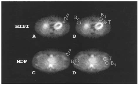 A comparison of 99Tcm-MDP and 99Tcm-MIBI in the detection of ...