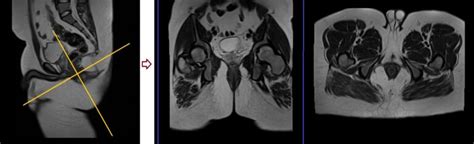 Anal Fistula MRI Perianal Fistula With Contrast Protocol And Planning