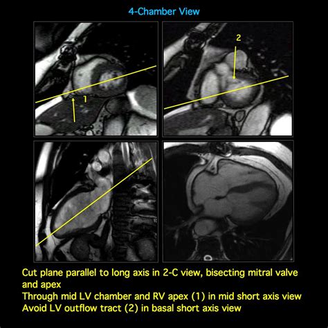 MRI BLOG: Cardiac MRI - Imaging Planes for Basic Cardiac Views