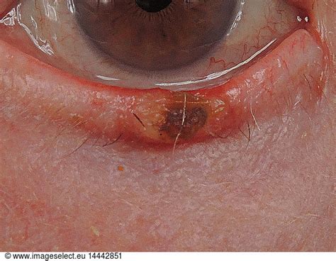 Well Differentiated Invasive Squamous Cell Carcinoma Developed On A Keratoacanthoma Of The Lower