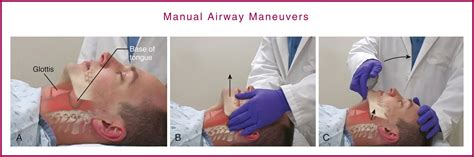 Basic Airway Management And Decision Making Clinical Tree