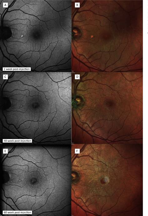 Figure From Multimodal Imaging Of Macular Subretinal Deposits