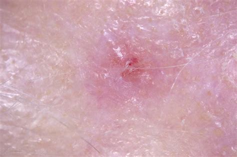 White Spots On Skin Cancer