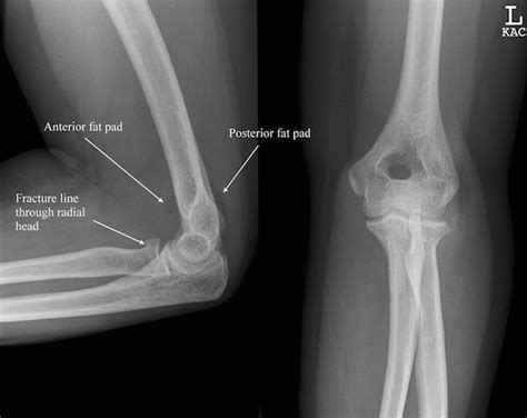 Radial Head Fracture Classification