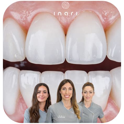 La Importancia De La Est Tica Dental Inari Estudio Dental