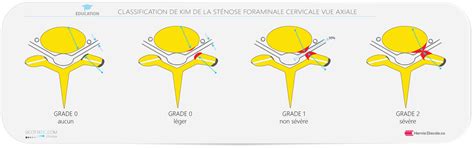 Rétrécissement foraminal L essentiel à savoir ONCAUVERGNE