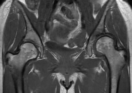 Adult Hip Dysplasia Radiology Case Radiopaedia Org