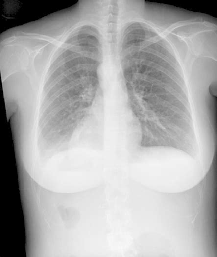 Chest X Ray Showing Dextrocardia With Bronchiectasis High Resolution Images