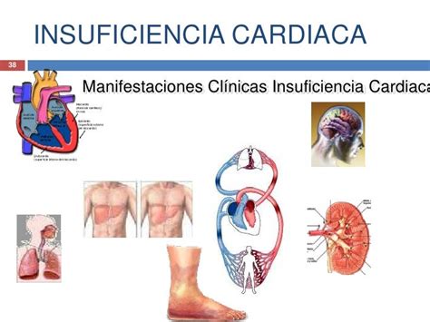 Causas De Insuficiencia Cardiaca