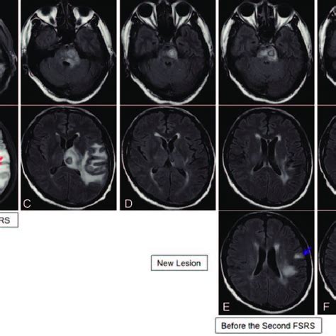 Cranial Magnetic Resonance Imaging Mri Scans Revealed The Sizes Of