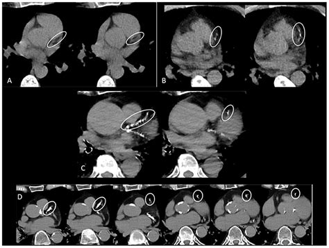 Frontiers Prognostic Value Of Coronary Artery Calcium Score In