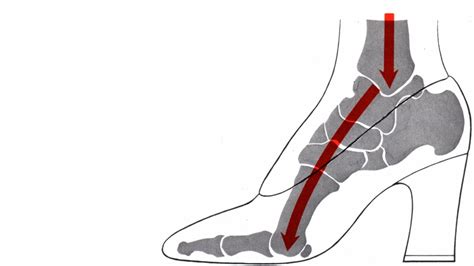 Metatarsalgia (Ball of Foot Pain): Symptoms and Causes – Page 3 ...