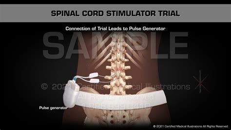 Spinal Cord Stimulator Scs Trial Youtube