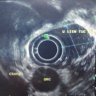 Toupet fundoplication during laparoscopy. | Download Scientific Diagram