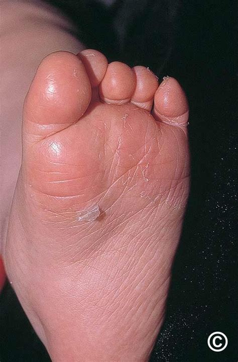 Itchy Peeling Skin On Bottom Of Foot Best Sale Emergencydentistry