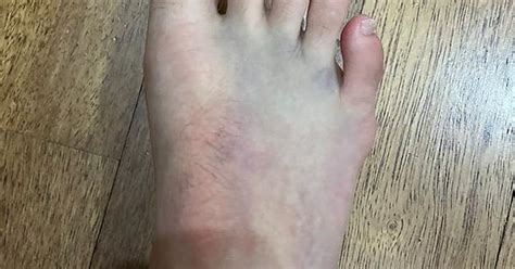 Ankle Bruise Album On Imgur