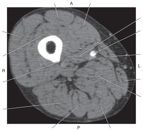 Axial Ct Of Right Mid Femur Diagram Quizlet