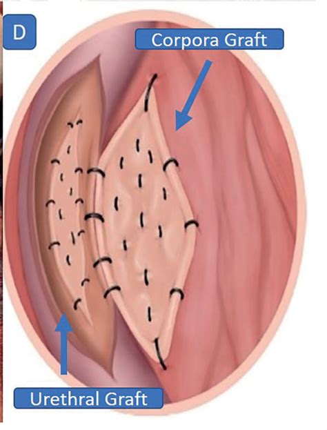 V Lvula De Uretra Posterior Dr Ubirajara Barroso Jr Urologia