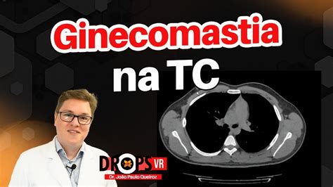 COMO RECONHECER GINECOMASTIA NA TOMOGRAFIA I VOCÊ RADIOLOGISTA YouTube