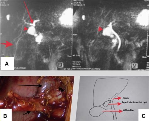 Hepatic Hilum Type Ii Choledochal Cyst Masquerading As Gallbladder Duplication Bmj Case Reports