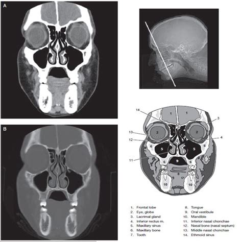 Sinus CT Scan - RadTechOnDuty