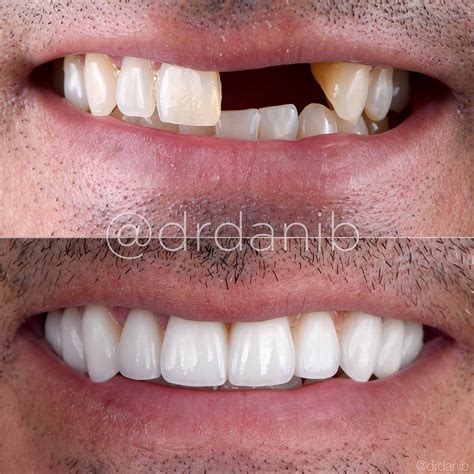 Cosmetic Dentistry Before & After Gallery - Dr. Dani B. Veneers