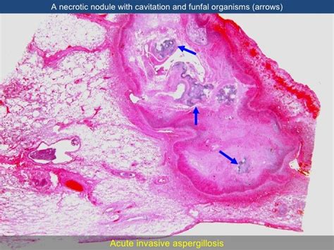 Invasive Aspergillosis