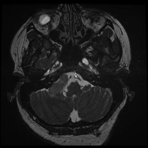 Acoustic Schwannoma Radiopaedia Axial T Nc Commons