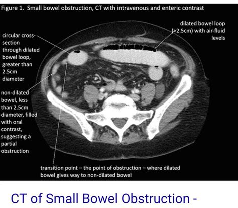 Pin By Liznel Feliberty On Imagenes De Ct Scan Y Mri Small Bowel