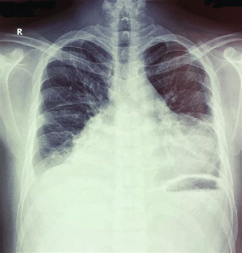 Chest X Ray Showing Bilateral Pleural Effusion With Cardiomegaly