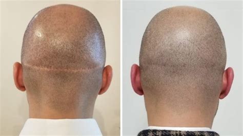 Hair Transplant Scar: Getting Rid Of & Repair Options - Bald & Beards