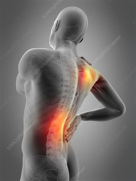 Shoulder and waist pain, illustration - Stock Image - F016/8483 - Science Photo Library