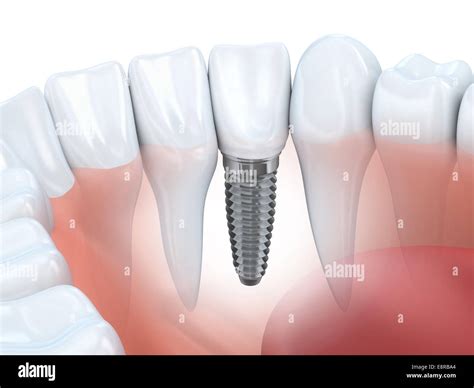 3d Molar Hi Res Stock Photography And Images Alamy