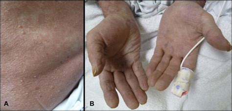 Pustular Eruption In The Icu The American Journal Of Medicine Blog