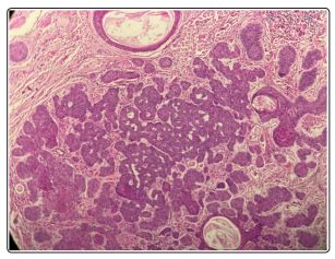 Fulltext | Desmoplastic Trichoepithelioma: An Unusual Location