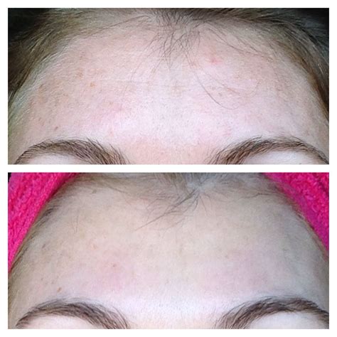 3 weeks before (top) and after with Arbonne RE9 Advanced Skin care and GENIUS Shop online at: w ...