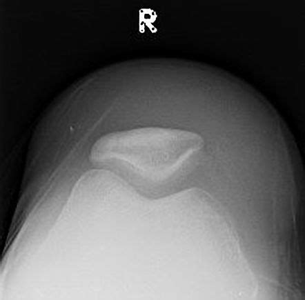 Prepatellar Bursitis Image Radiopaedia Org